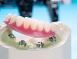 Closeup/ Dental implants supported overdenture on blue background/ Screw retained/ implant restorations.