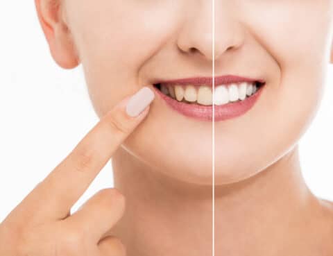 Teeth whitening before after close-up