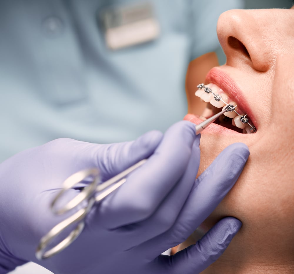 Orthodontist hands placing braces on woman teeth.