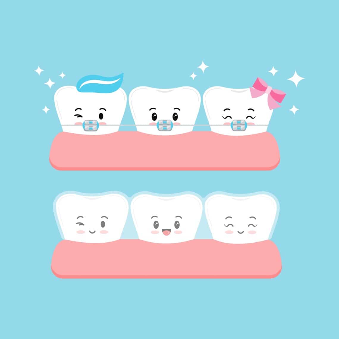 Invisible braces and brackets on tooth set. Dental invisalign braces vs metal white tooth orthodontic correction treatment concept. Vector flat design kawaii kid tooth dentistry mascot illustration.