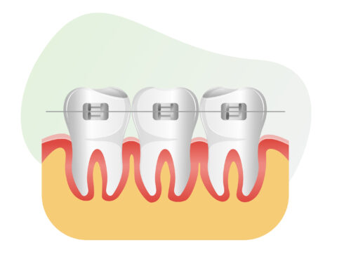 Set of Teeth with Dental Braces - stock illustration as EPS 10 File