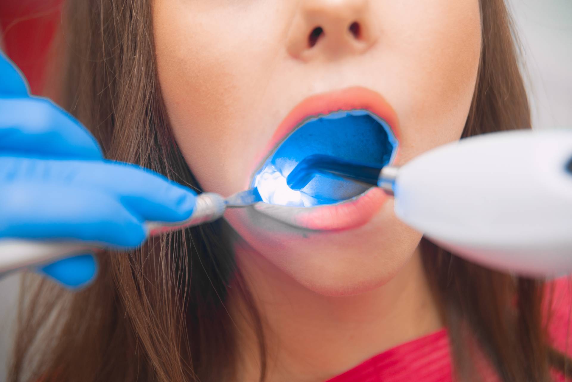 Dental restoration in dentistry with a photopolymer lamp. The girl at the dentist's appointment. Close-up of the oral cavity