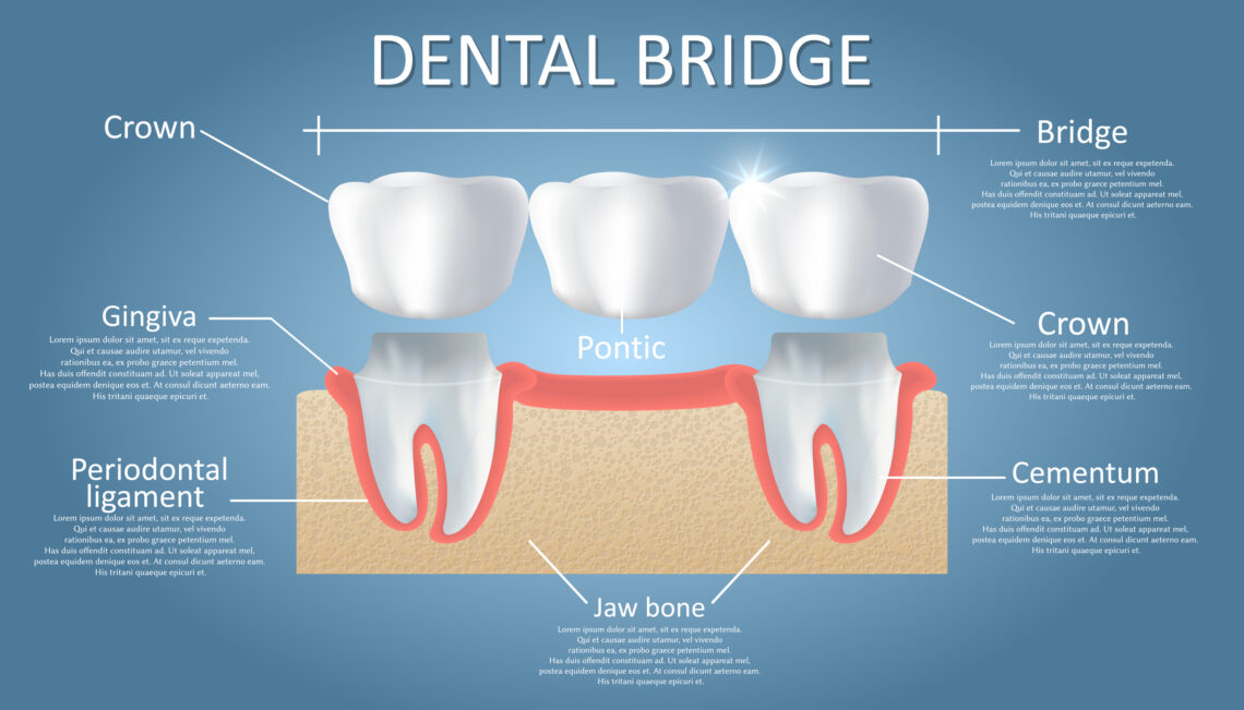 Dental bridge diagram. Vector educational poster, medical infographic. Traditional bridge consists of one artificial tooth and is held in place by dental crowns. Fixed dental restoration.