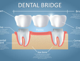 Dental bridge diagram. Vector educational poster, medical infographic. Traditional bridge consists of one artificial tooth and is held in place by dental crowns. Fixed dental restoration.