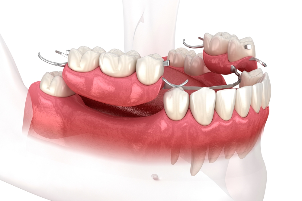 Removable partial denture, mandibular prosthesis. Medically accurate 3D illustration of prosthodontics concep