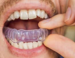 Man placing a bite plate in his mouth to protect his teeth at night from grinding caused by bruxism, close up view of his hand and the appliance BANNER, LONG FORMAT
