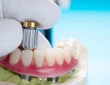 Closeup/ Dental implants supported overdenture on blue background/ Screw retained/ implant restorations.