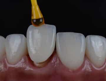 Placing all ceramic crown to cover darken front teeth. Close up intra oral macro shot.