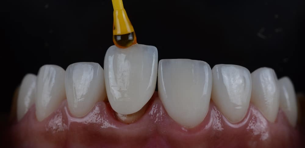 Placing all ceramic crown to cover darken front teeth. Close up intra oral macro shot.