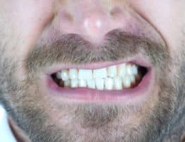 Angry Man Grinding Teeth, Close Up