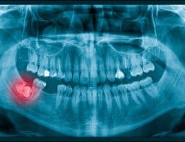 Growing Wisdom Toothache On X-Ray